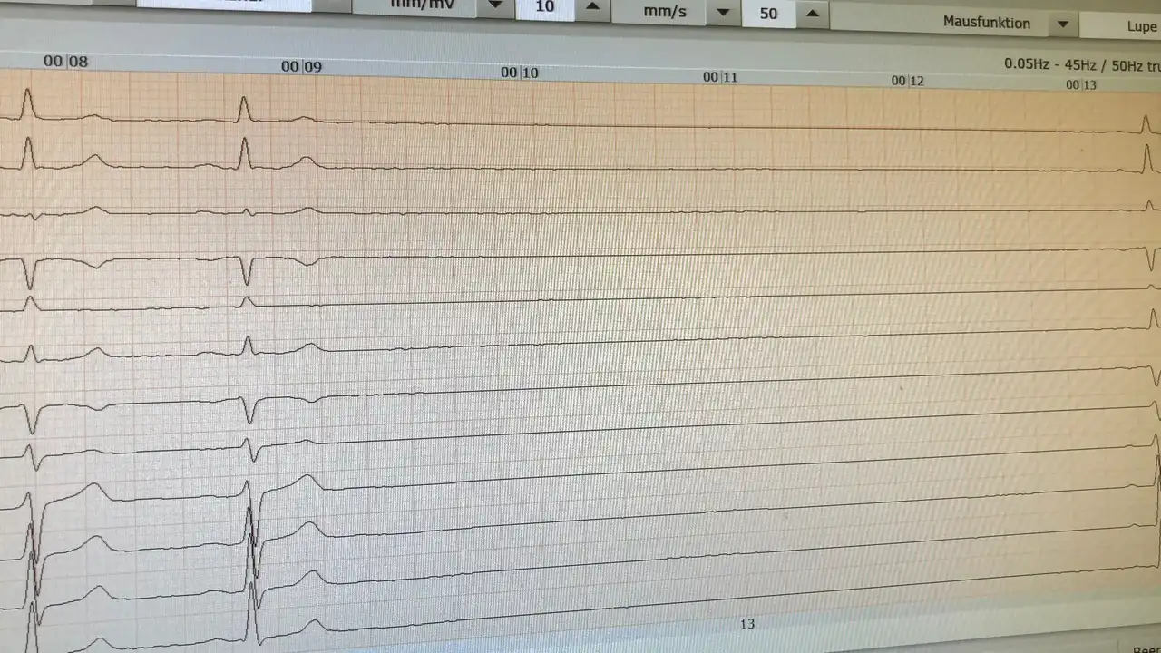 Aufzeichnung eines EKGs