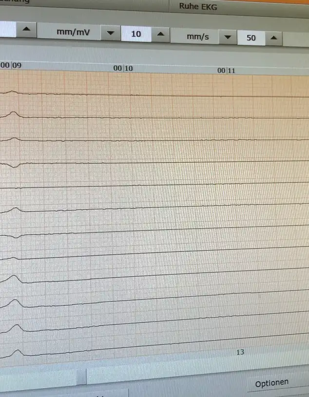 Aufzeichnung eines EKGs